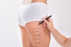 Surgeon preparing woman for thigh lift surgery