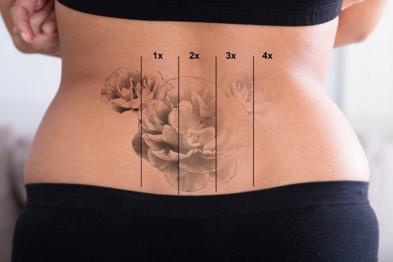 Tattoo Removal » Bothell, WA Medspa - Dr. Robert Dragotti - Tao Cosmetics